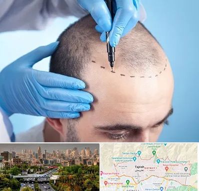 دکتر کاشت مو در منطقه 1 تهران 