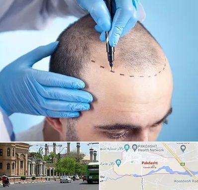 دکتر کاشت مو در پاکدشت