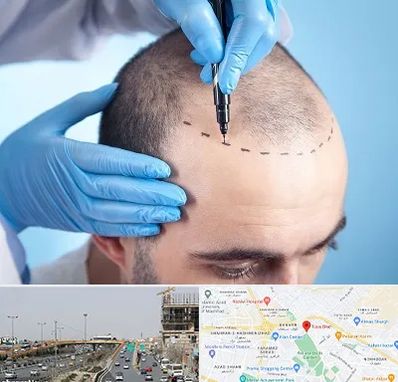 دکتر کاشت مو در بلوار توس مشهد 