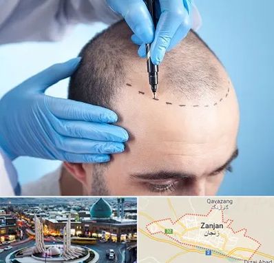 دکتر کاشت مو در زنجان