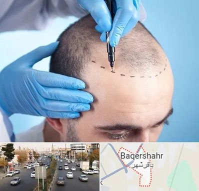 دکتر کاشت مو در باقرشهر