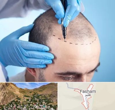 دکتر کاشت مو در فشم