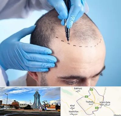 دکتر کاشت مو در تایباد