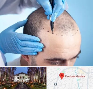 دکتر کاشت مو در باغ فردوس