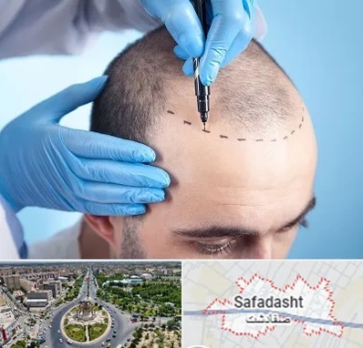 دکتر کاشت مو در صفادشت