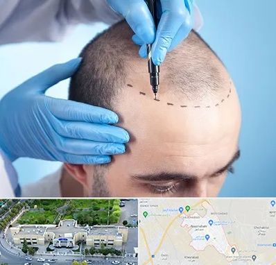 دکتر کاشت مو در نسیم شهر