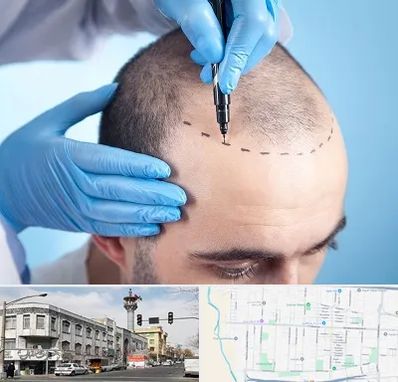 دکتر کاشت مو در 17شهریور