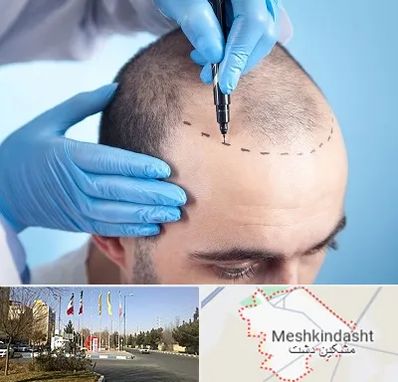 دکتر کاشت مو در مشکین دشت