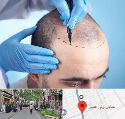 دکتر کاشت مو در ولیعصر شهریار