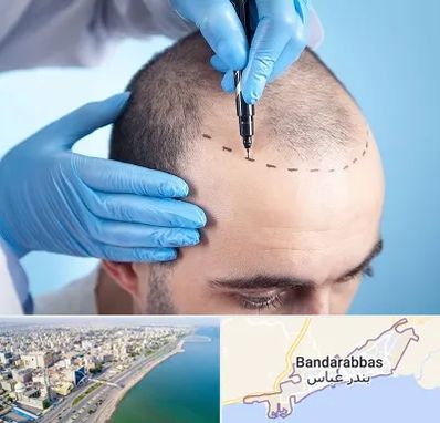 دکتر کاشت مو در بندرعباس