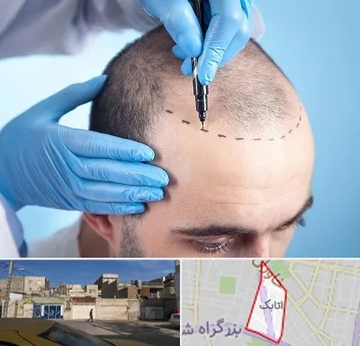 دکتر کاشت مو در اتابک