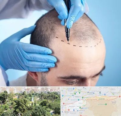 دکتر کاشت مو در منطقه 13 تهران 