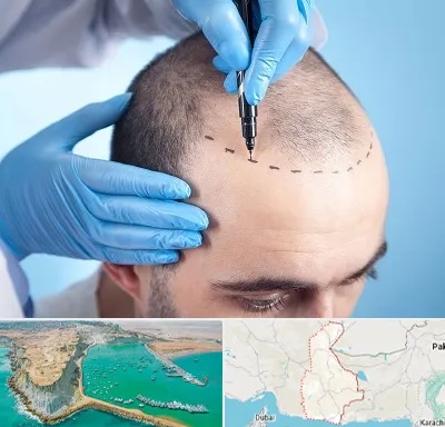 دکتر کاشت مو در سیستان و بلوچستان