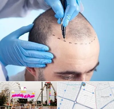 دکتر کاشت مو در پادادشهر اهواز