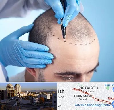 دکتر کاشت مو در فرمانیه 