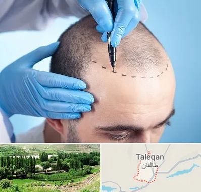 دکتر کاشت مو در طالقان