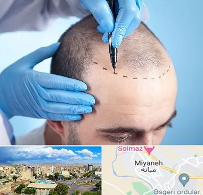 دکتر کاشت مو در میانه