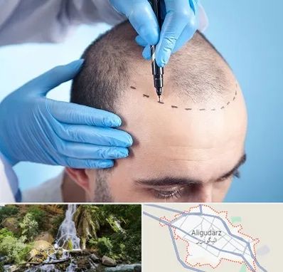 دکتر کاشت مو در الیگودرز