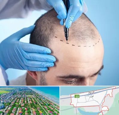 دکتر کاشت مو در نور