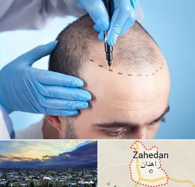 دکتر کاشت مو در زاهدان
