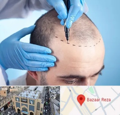 دکتر کاشت مو در بازار رضا مشهد