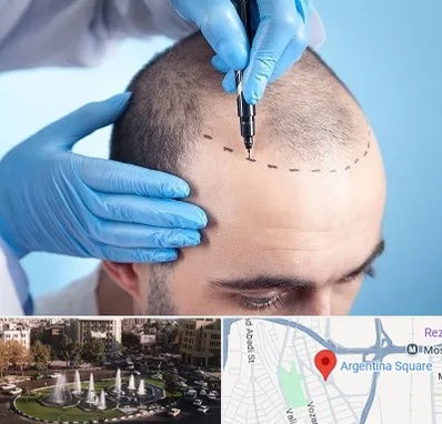 دکتر کاشت مو در آرژانتین