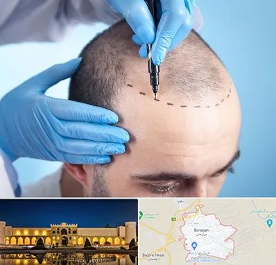 دکتر کاشت مو در برازجان