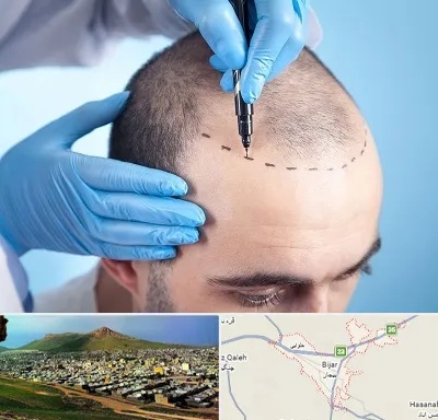 دکتر کاشت مو در بیجار