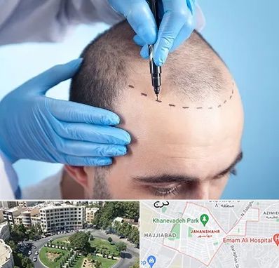 دکتر کاشت مو در جهانشهر کرج 