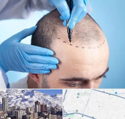 دکتر کاشت مو در ازگل