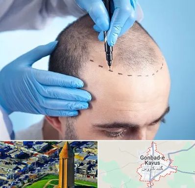 دکتر کاشت مو در گنبد کاووس