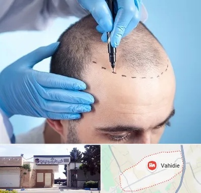 دکتر کاشت مو در وحیدیه شهریار