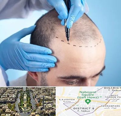 دکتر کاشت مو در نارمک 
