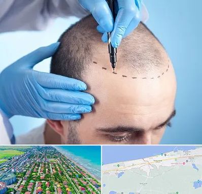 دکتر کاشت مو در فریدونکنار