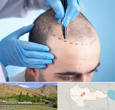 دکتر کاشت مو در خاش