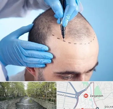 دکتر کاشت مو در زرگنده