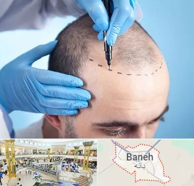 دکتر کاشت مو در بانه