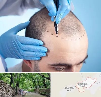 دکتر کاشت مو در شاندیز مشهد