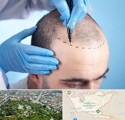 دکتر کاشت مو در شهرکرد