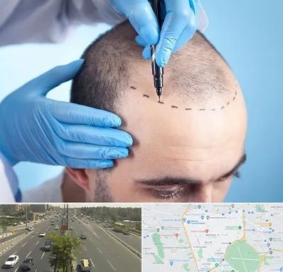 دکتر کاشت مو در منطقه 17 تهران 