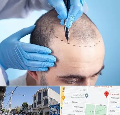 دکتر کاشت مو در افسریه 