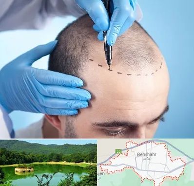 دکتر کاشت مو در بهشهر