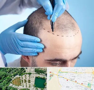 دکتر کاشت مو در وکیل آباد مشهد 