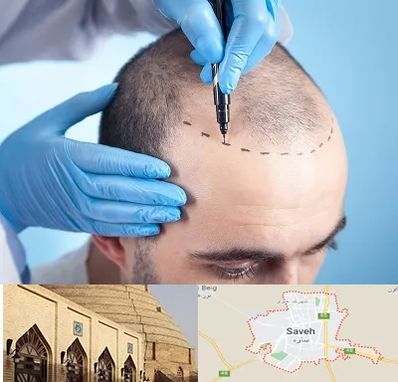 دکتر کاشت مو در ساوه
