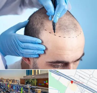 دکتر کاشت مو در لاله پارک تبریز