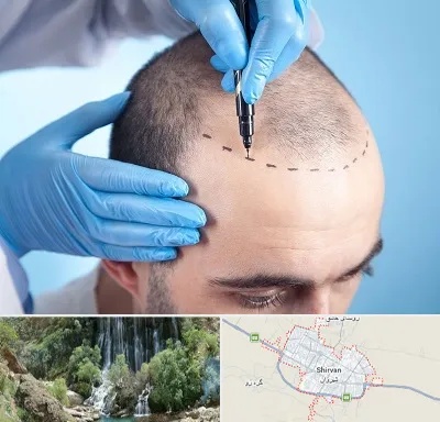 دکتر کاشت مو در شیروان