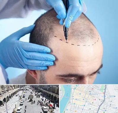 دکتر کاشت مو در نادری اهواز