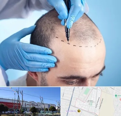 دکتر کاشت مو در فاز دو اندیشه