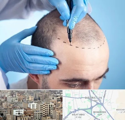 دکتر کاشت مو در جنوب شرق تهران