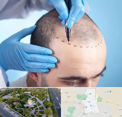 دکتر کاشت مو در کاشمر